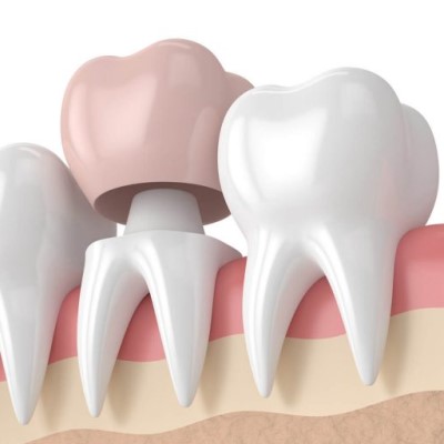 Dental Crowns Etobicoke