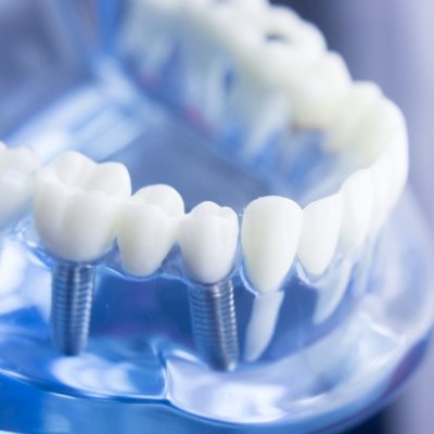 Dental Implants Etobicoke